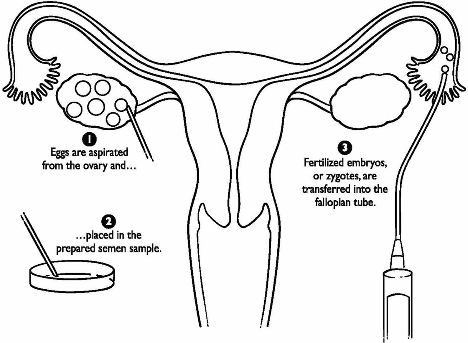 Tubal Embryo Transfer (TET)